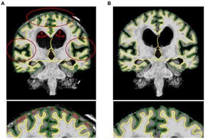 Methodological challenges of measuring brain volumes and cortical thickness in idiopathic normal pressure hydrocephalus with a surface-based approach